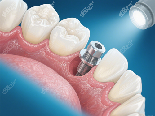 種植牙手術(shù)示意圖
