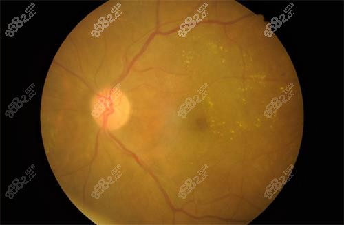 視網(wǎng)膜色素變性示意圖 視網(wǎng)膜色素變性示意圖