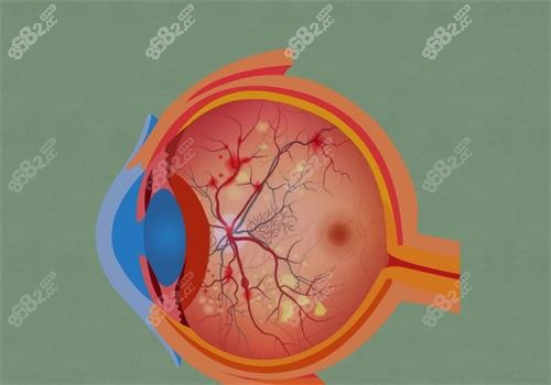 視網(wǎng)膜色素變性的眼睛 視網(wǎng)膜色素變性的眼睛