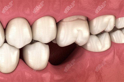 缺牙牙齒松動(dòng) 缺牙牙齒松動(dòng)