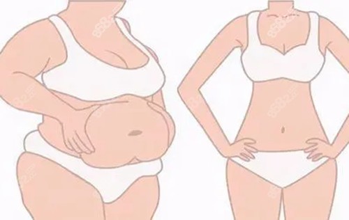 全身吸脂前后對(duì)比示意圖