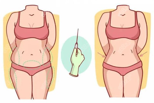 吸脂填充術(shù)