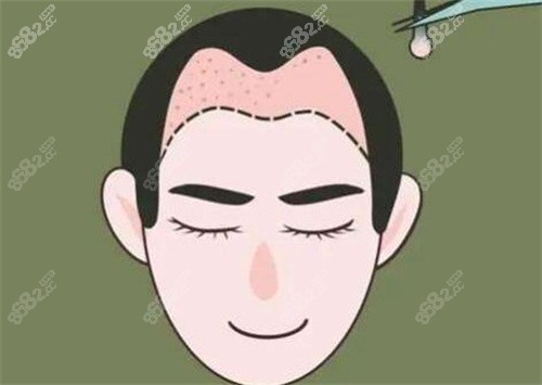 M型發(fā)際線種植