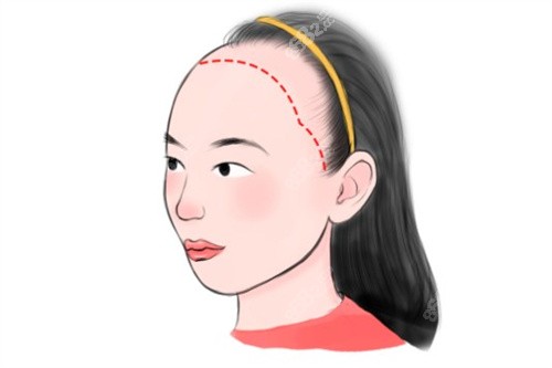 女型發(fā)際線種植卡通