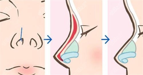 鼻部綜合隆鼻術(shù)前術(shù)后展示圖