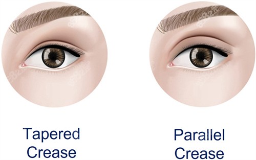 雙眼皮加寬手術(shù)前后對比圖