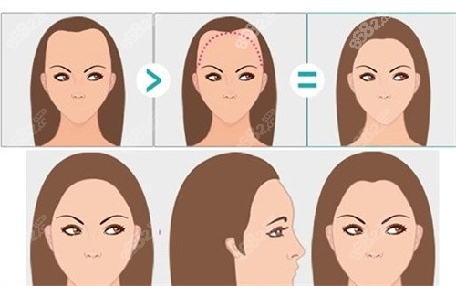 女性m型發(fā)際線卡通圖