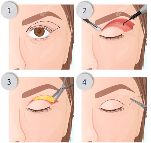切開型雙眼皮手術(shù)過程