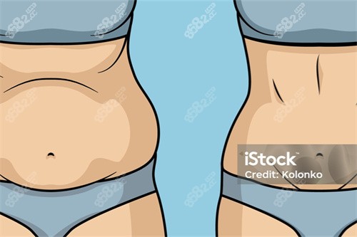 產(chǎn)后吸脂展示圖