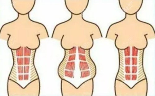 腹壁成形手術(shù)卡通示意圖