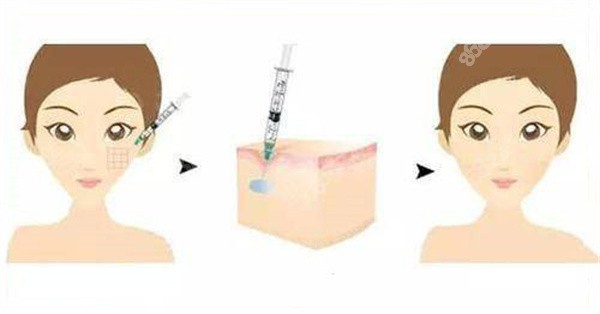 瑞藍唯瑅玻尿酸適合打哪個部位