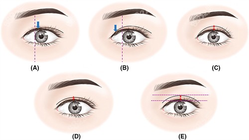 調(diào)整雙眼皮寬度