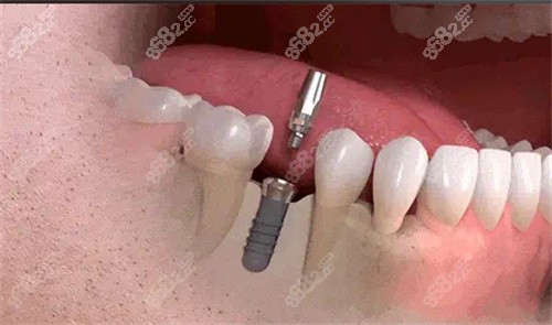 種植牙操作模型圖片