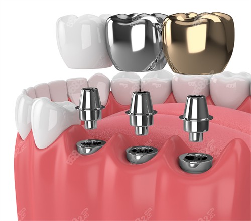 不同牙冠的種植牙