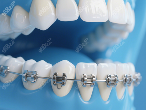 牙齒矯正示意圖