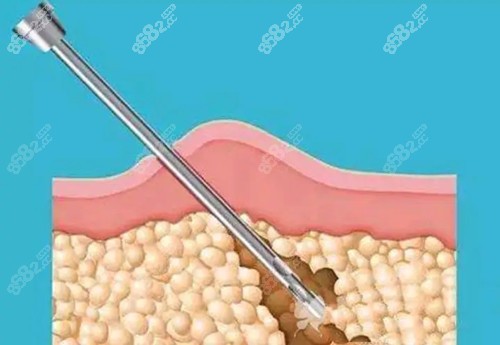 負(fù)壓吸脂卡通示意圖