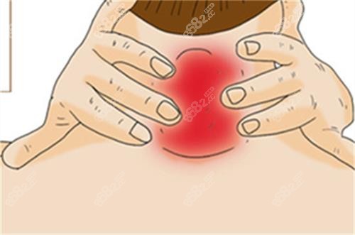 自測是否有富貴包的方法圖解