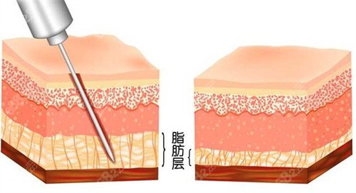 吸脂手術(shù)怎么做的