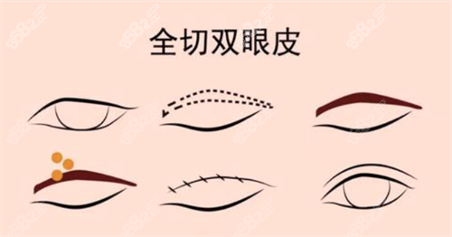 全切雙眼皮經(jīng)過