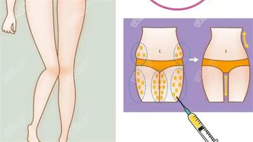 大腿吸脂手術(shù)