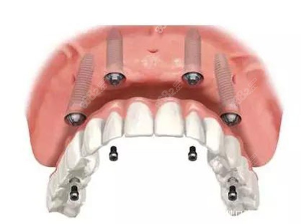 揭秘海西種植牙24小時(shí)在線