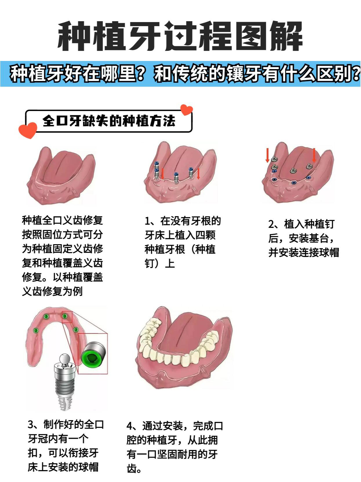 淮安漣水牙管家口腔門診部 - 漣水地區(qū)的種植牙優(yōu)選