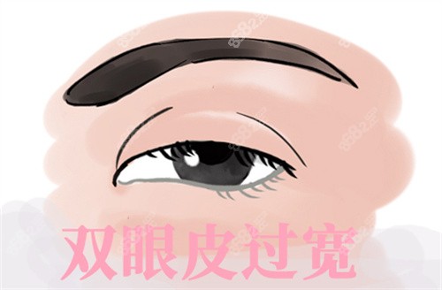 雙眼皮過寬修復