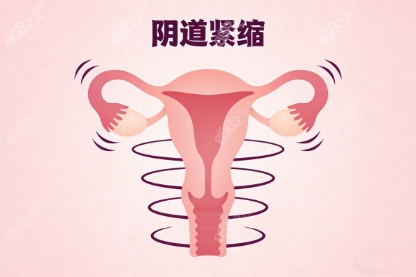 陰道緊縮卡通圖展示