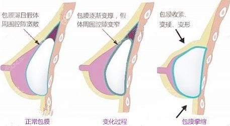 假體隆胸包膜攣縮