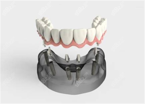 半口種植牙卡通圖示意圖