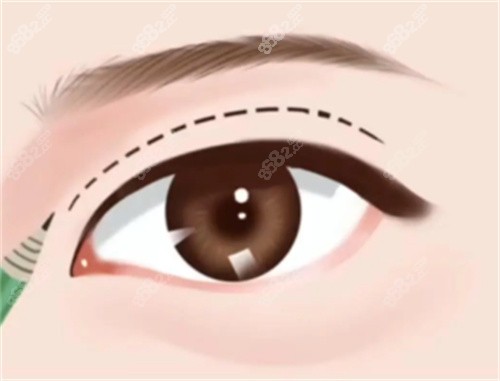 全切雙眼皮手術卡通圖片