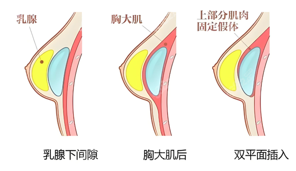 假體隆胸植入層次