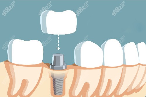 單顆種植牙牙冠安裝漫畫圖