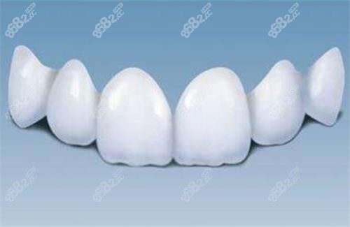 全瓷牙的示意圖
