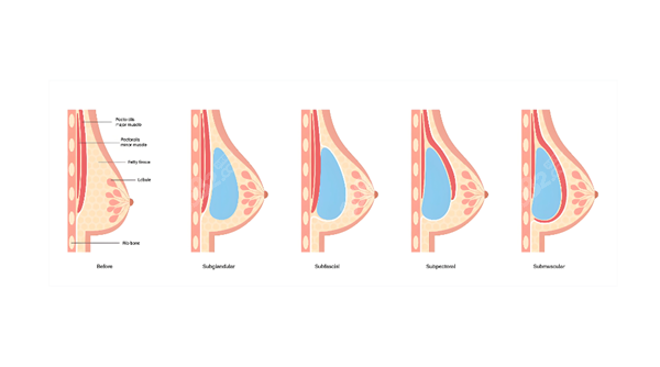 假體隆胸手術(shù)展示圖