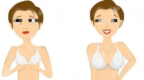 2026重慶隆胸手術(shù)要花多少？進口國產(chǎn)假體超詳細價目表讓你一眼看懂