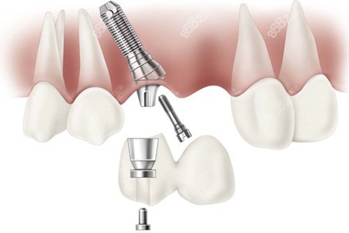 種植牙一拖二成效圖