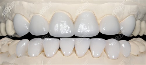 全瓷牙的光澤和顏色
