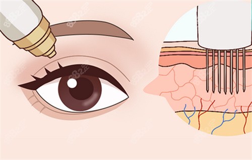眼部黃金微針卡通圖