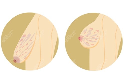 胸部下垂手術(shù)前后示意圖