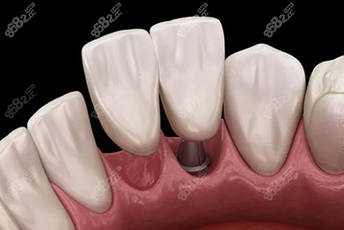 種植牙一拖二內(nèi)部展示圖