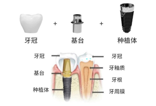 威高種植牙手術(shù)過程示意圖