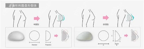 隆胸手術(shù)過程