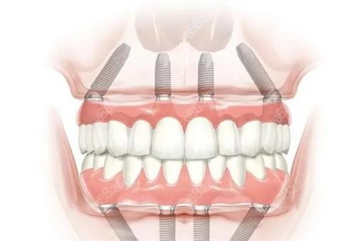 2026蘭州種植牙價格公示：含韓系、瑞士ITI、瑞典諾貝爾單顆及全口費(fèi)用