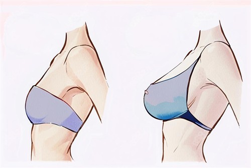 陳德法醫(yī)生隆胸怎么樣？評價好嗎？2026陳德法假體隆胸抗攣縮技術(shù)解析