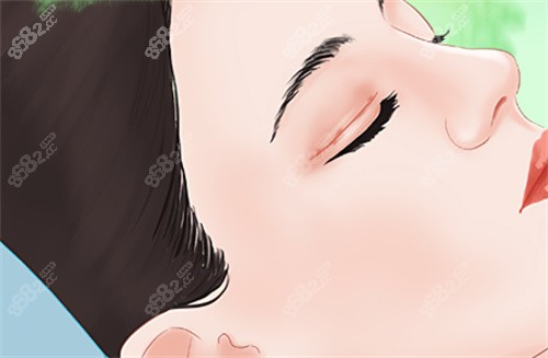 需要雙眼皮修復(fù)的眼睛