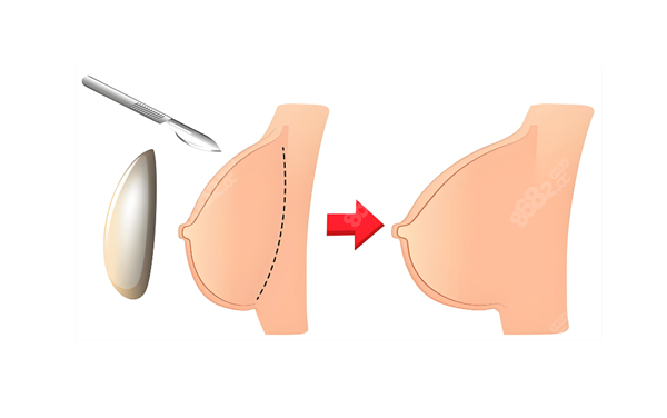 假體隆胸過(guò)程圖