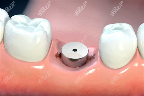 單顆種植牙愈合基臺卡通圖