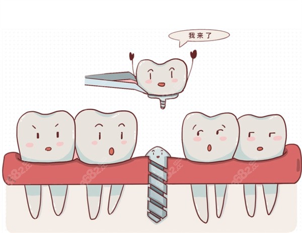 種植牙治療卡通圖
