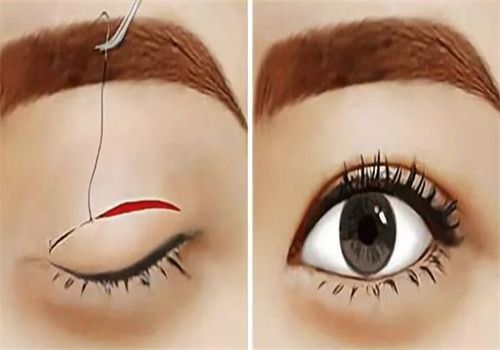 北京魏志香醫(yī)生做的外切眼袋修復術7天成效反饋：淤血輕、疤痕隱、效果顯著